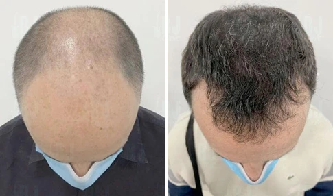 Antes y después Antes y después
