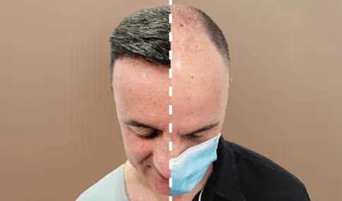 Evolución injerto capilar mes a mes