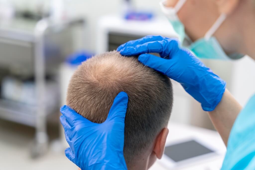 ¿Se puede combatir la alopecia areata con tratamiento minoxidil?