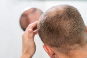 ¿Cuánto dura la fase desierto injerto capilar?