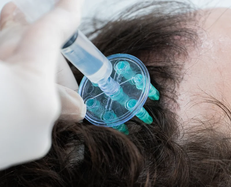 Mesoterapia Capilar Barcelona