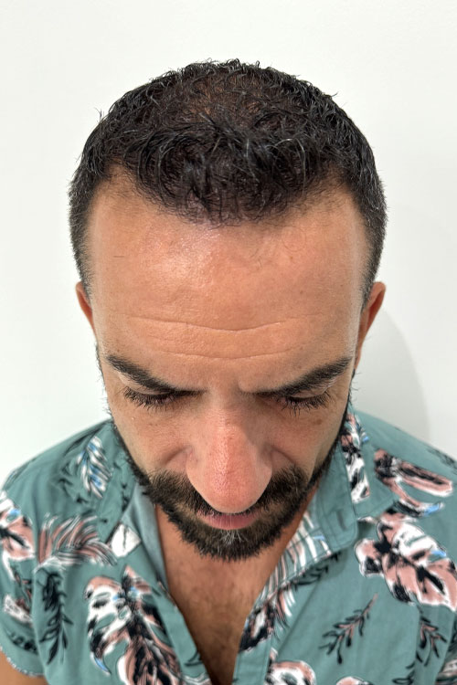 Después del Injerto Capilar Barcelona