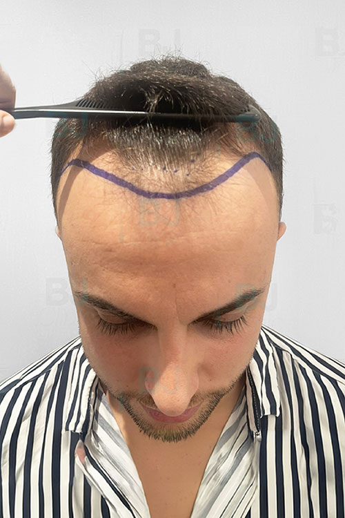 Antes y después injerto capilar