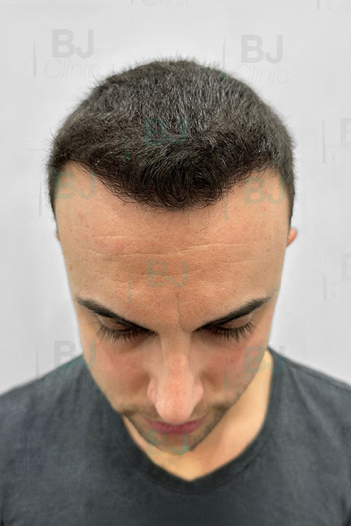 Antes y después injerto capilar