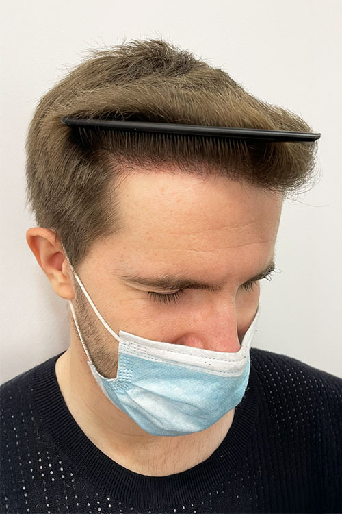 Antes y después injerto capilar