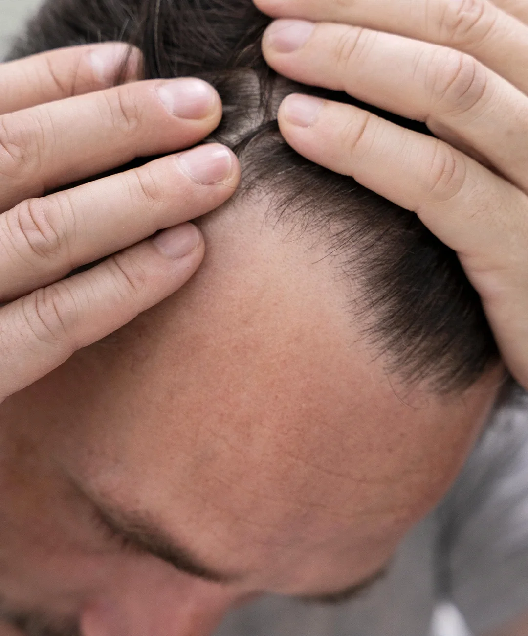 Dutasteride Tratamiento Capilar Barcelona