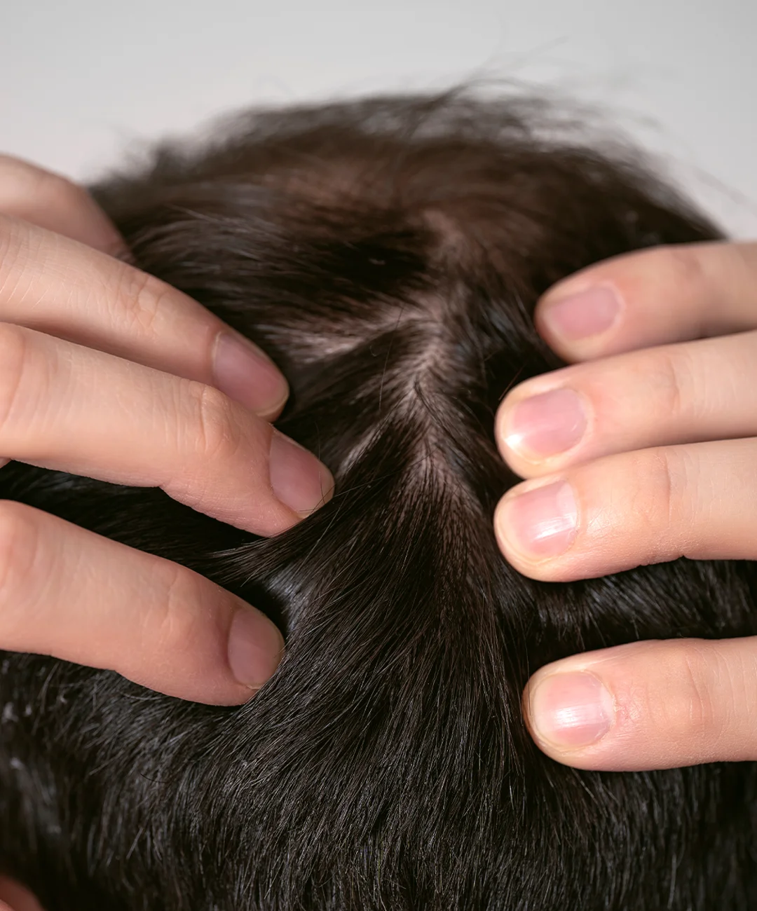 Dutasteride Beneficios