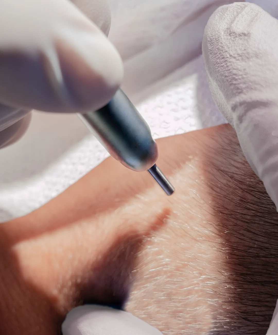 Injerto capilar entradas Injerto capilar entradas