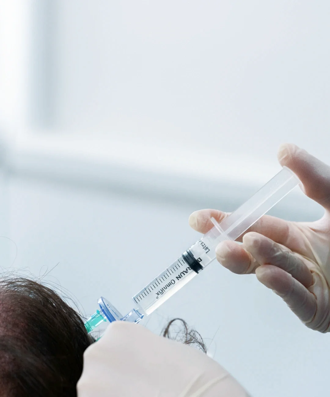 Mesoterapia capilar Mesoterapia capilar