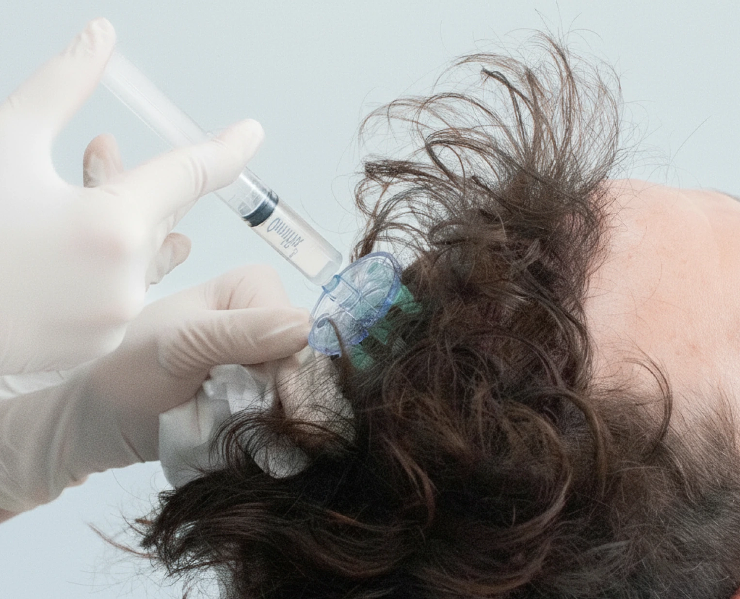 Mesoterapia Capilar Barcelona Mesoterapia Capilar Barcelona