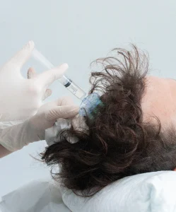 Mesoterapia Capilar Barcelona