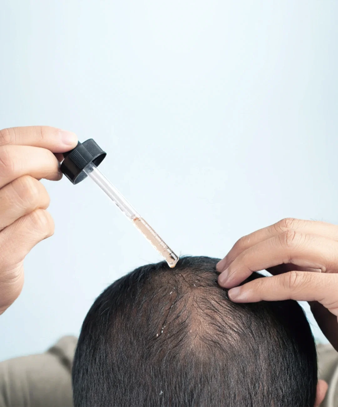 Minoxidil Barcelona Minoxidil Barcelona