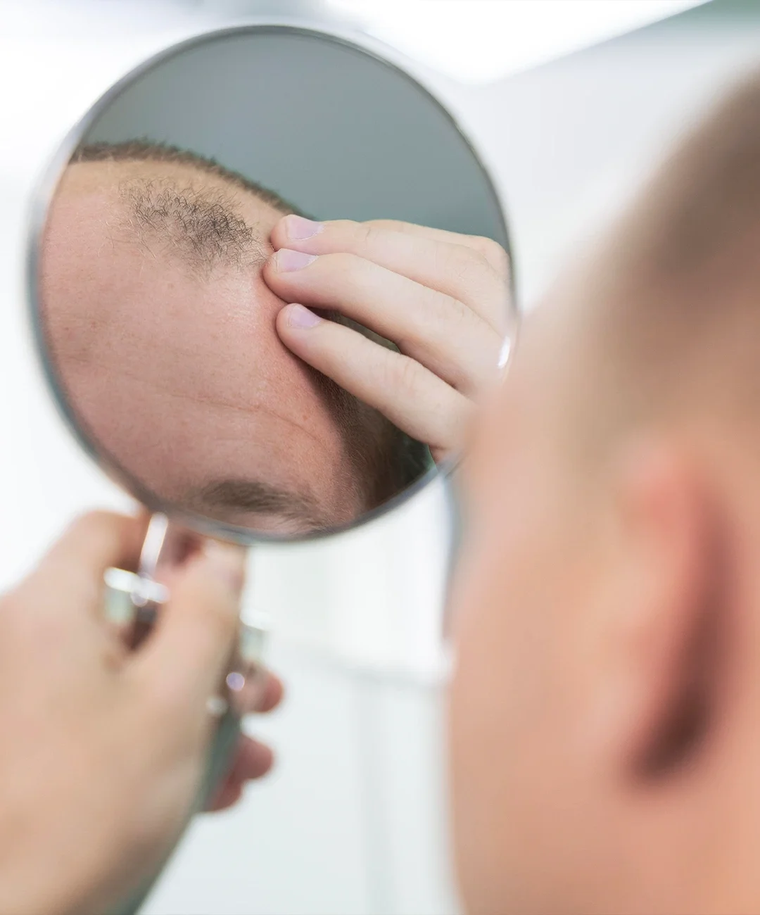 Minoxidil Resultados Minoxidil Resultados