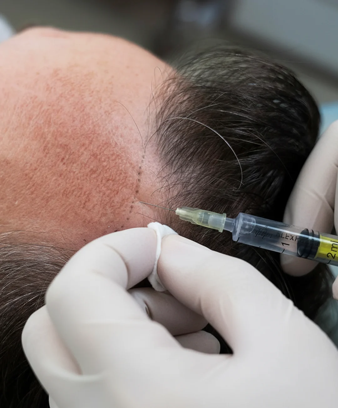 Tratamientos Anticaída Seguros