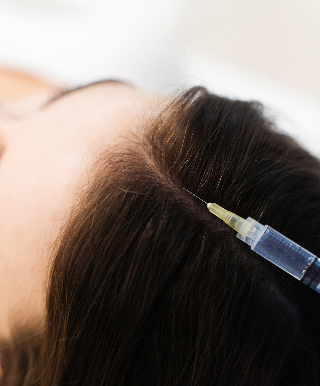 injerto capilar mujer injerto capilar mujer