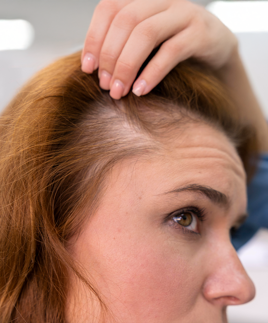 injerto capilar mujer