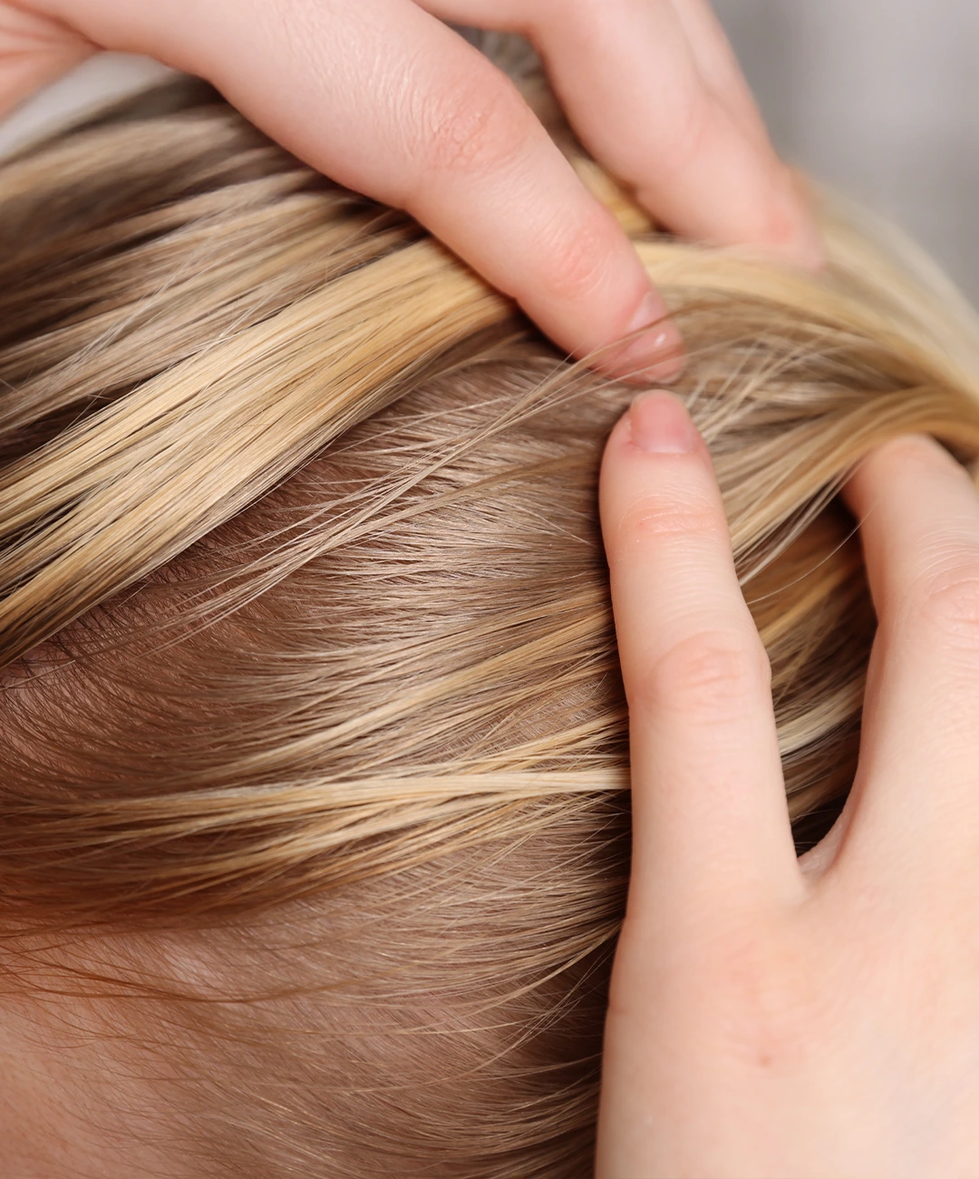 injerto capilar mujer injerto capilar mujer