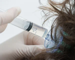 mesoterapia barcelona