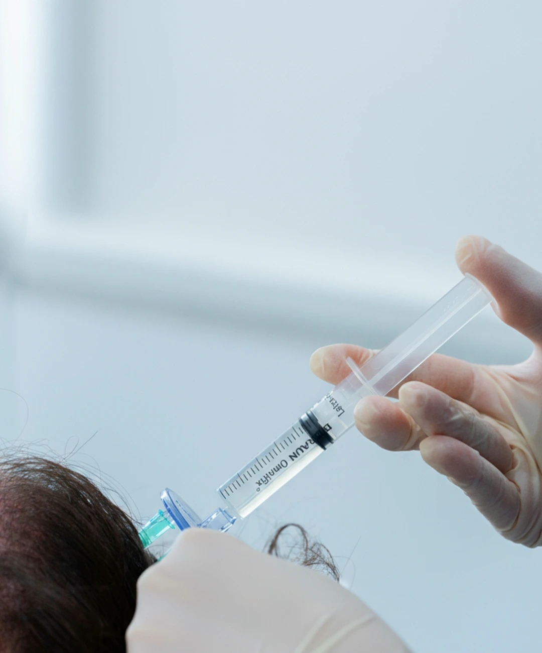 mesoterapia capilar mujer