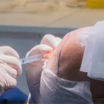 Shock Loss injerto capilar