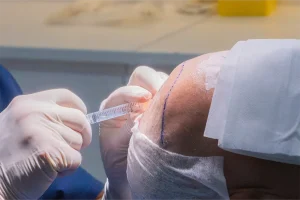 Shock Loss injerto capilar