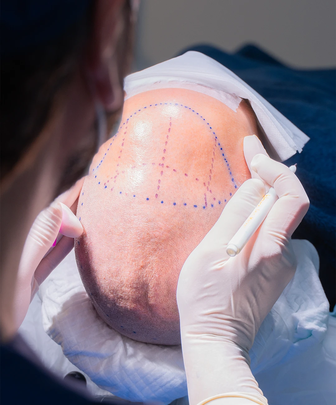 Técnica FUE postoperatorio