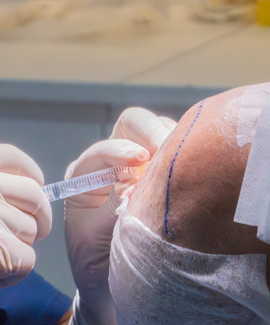Técnica FUE postoperatorio Técnica FUE postoperatorio