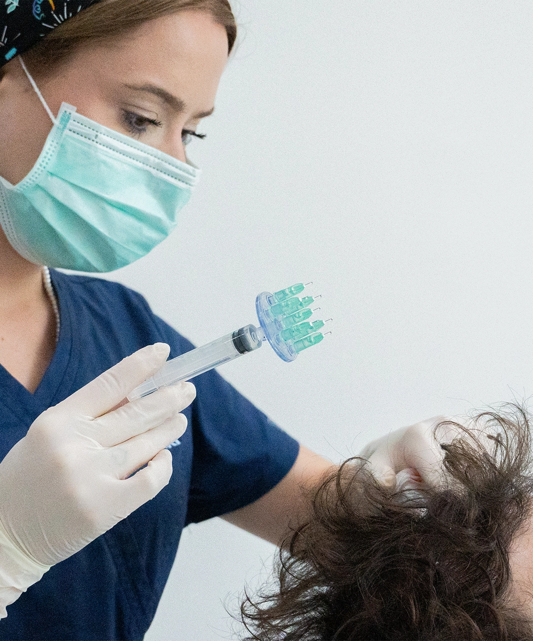 Mesoterapia capilar Girona