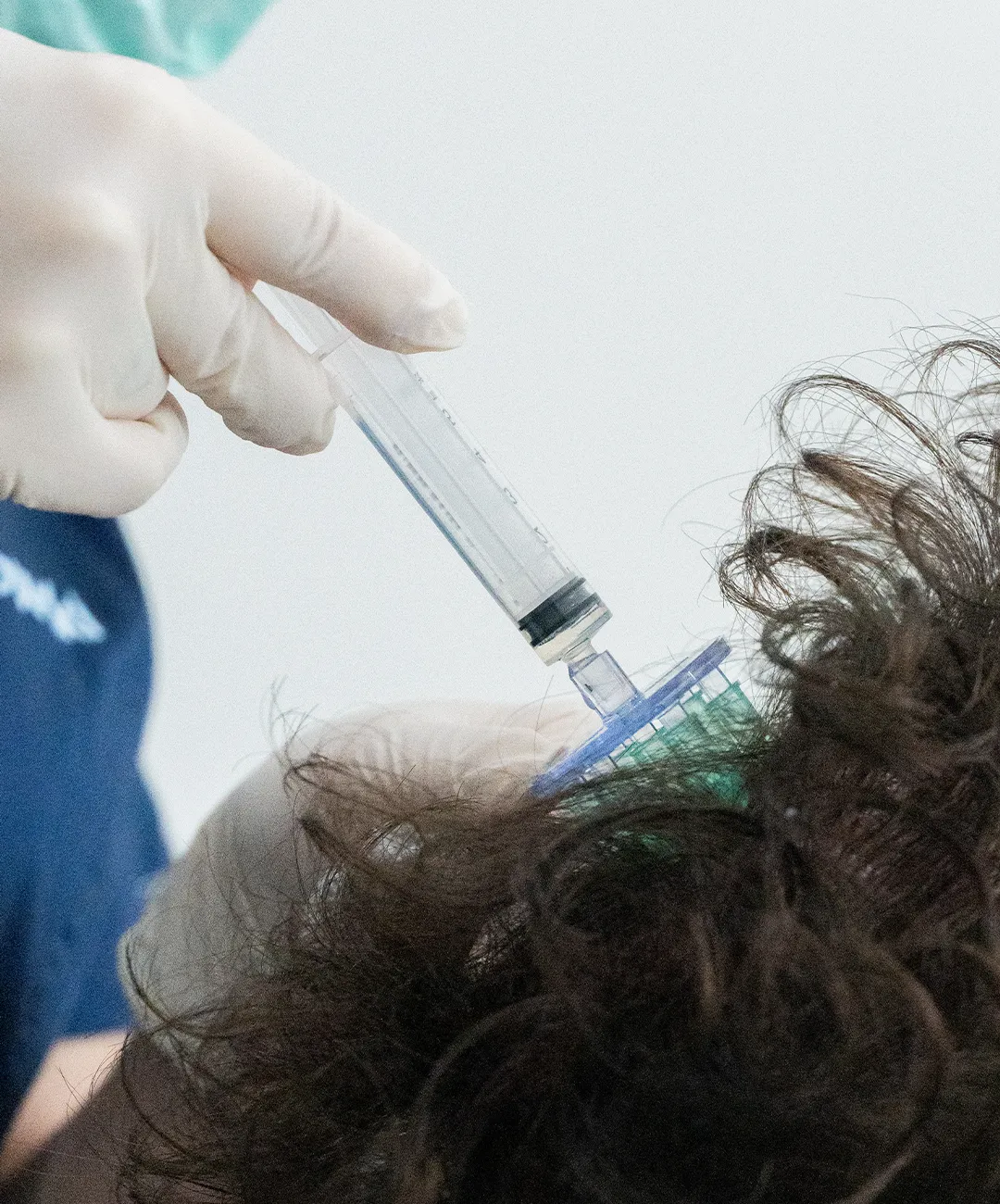 problemas de tiroides y la caída del cabello problemas de tiroides y la caída del cabello